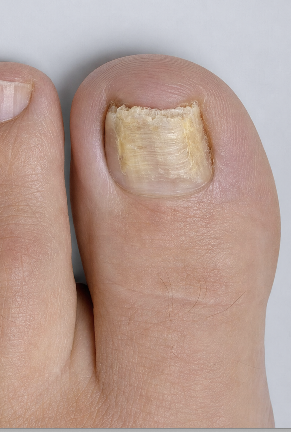 Nail Fungal Care